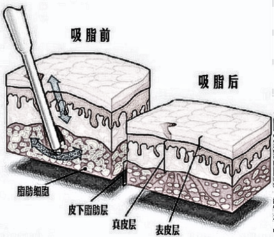 抽脂对身体有没有害呢?