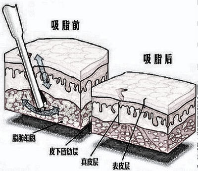 抽脂对身体有没有害呢？