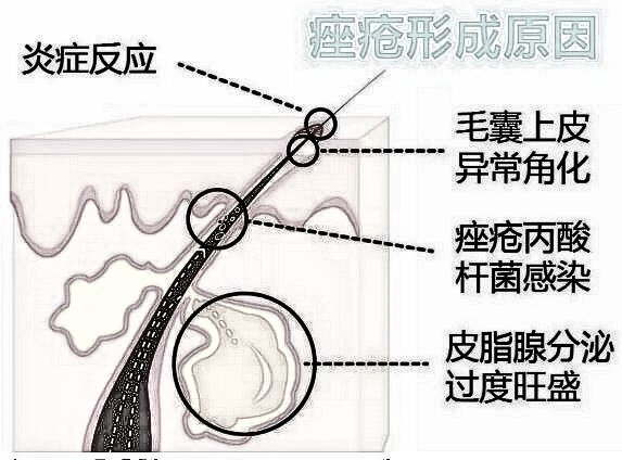 尝试果酸换肤美容美白后，终于填平了月球表面的烂脸！