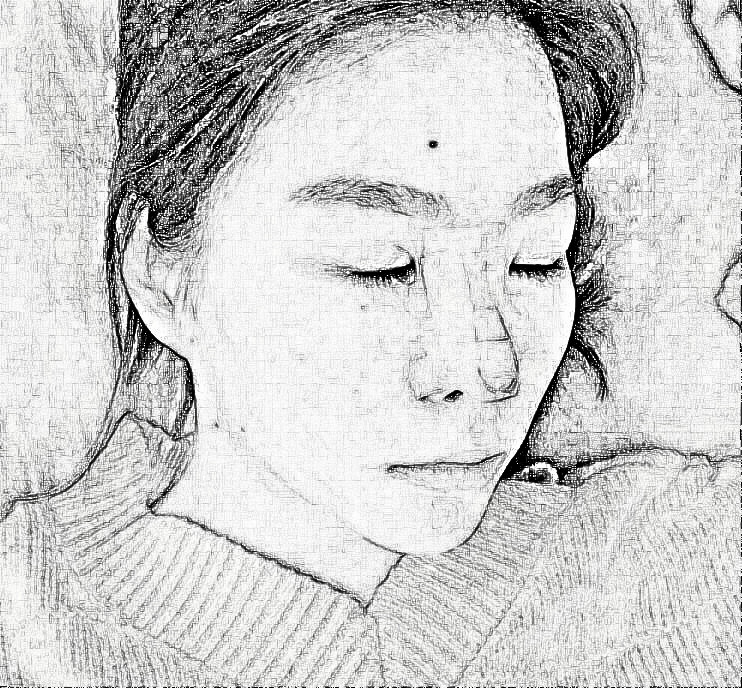 西安瑞丽郭永华医师隆鼻介绍 30天前后图分享
