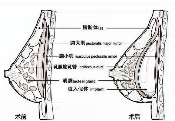 胸大是一种什么样的体验？关于隆胸你了解多少？