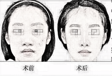 重庆华美整形张国强隆鼻怎么样？隆鼻收费详情一览！介绍分享