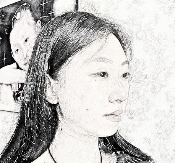 西安美立方李旭平医师隆鼻介绍 35天前后图分享