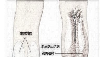 注射瘦腿果好吗