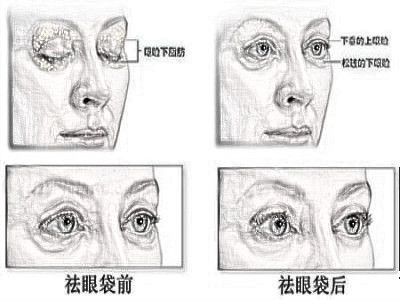 祛眼袋没问题吗 有哪些方法可以去眼袋