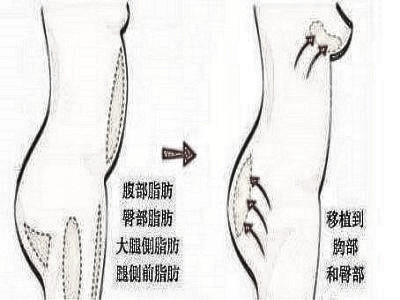 腰腹吸脂多少钱 有后遗症吗