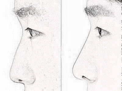 鼻尖整形需要多少钱 恢复时间是多久