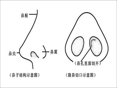 隆鼻后鼻子为什么会透光