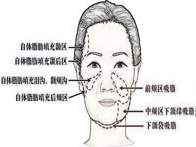 面部吸脂手术果好吗 需要注意些什么