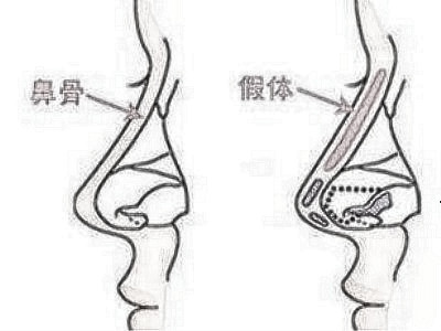 自体脂肪隆鼻果好吗 能维持多久