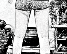 上海华美整形医院姜胜勋大腿吸脂介绍 60天前后图分享