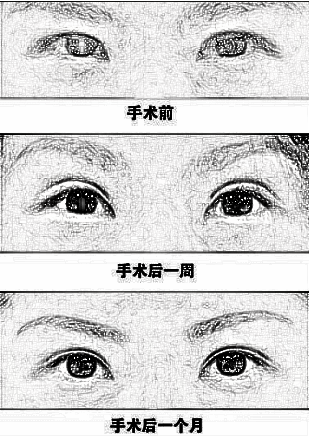 重庆艺星整形王方鹏做双眼皮怎么样？介绍前后90天图分享
