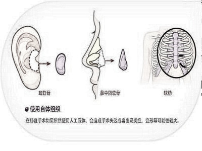 什么样的鼻子需要做修复