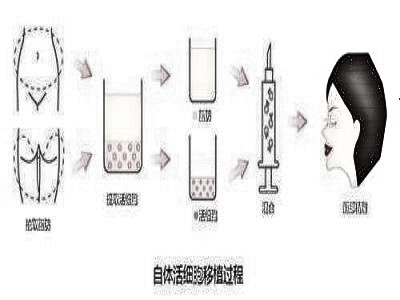 自体脂肪填充多方面部各部位的需求量