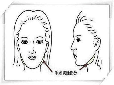 下颚角整形手术是什么