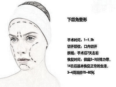 下颚角整形手术是什么