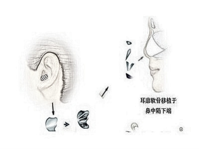自体软骨隆鼻受欢迎的原因