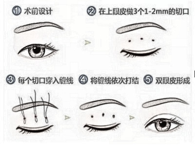 双眼皮整形应该怎么选手术方案