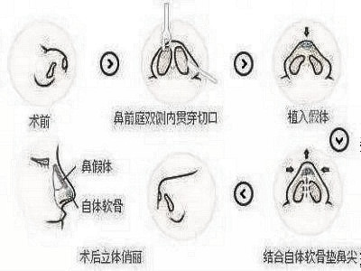 隆鼻整形后老了鼻子是怎么样的