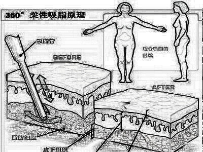 吸脂后究竟能瘦多少斤
