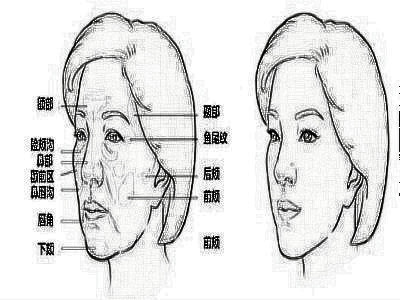 自体脂肪填充容易被吸收和移位吗