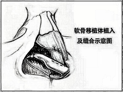 做鼻部手术整形你一定要知道这些