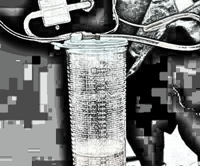 成都艺星美容医院黄文做大腿吸脂介绍,2个月前后图