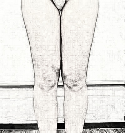 成都艺星美容医院黄文做大腿吸脂介绍,2个月前后图
