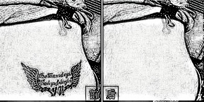 亳州美沃美整形医院正规吗 激光洗纹身疼吗