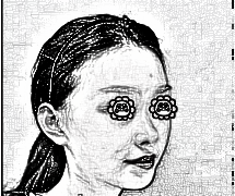 武汉协和郭科为我做的鼻子 耳软骨隆鼻术后125天果