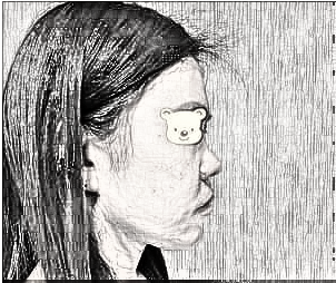 成都成美郑敏做鼻子怎么样?膨体隆鼻60天果