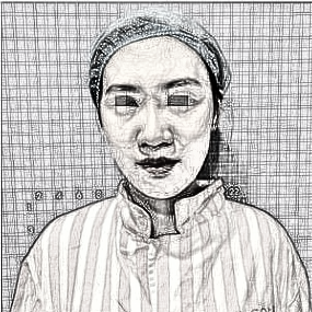 长沙华美车柄勋隆鼻怎么样?三个月术后果
