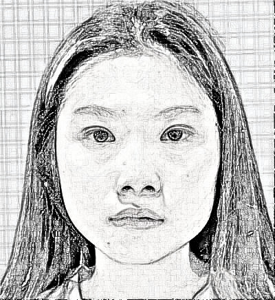 苏州康美美容做的面部吸脂，术后可以拥有迷人小V脸了