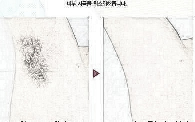 珠海华美整形医院激光脱腋毛有哪些优势 有