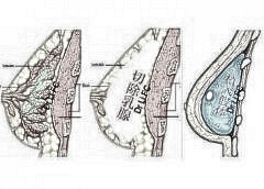 三明第二医院整形科乳房再造的优势 有副作用吗