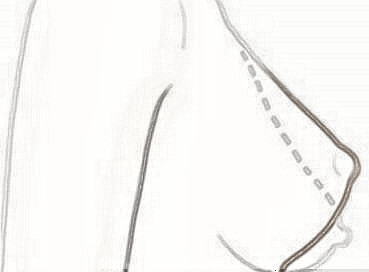 德州聚星整形医院乳房下垂矫正果好吗 术后咋护理
