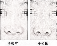 鼻头缩小术 摆脱大鼻头的尴尬