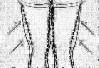 齐齐哈尔千百度大腿吸脂术可恢复苗条吗