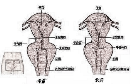 缩阴手术后多久可以爱爱?