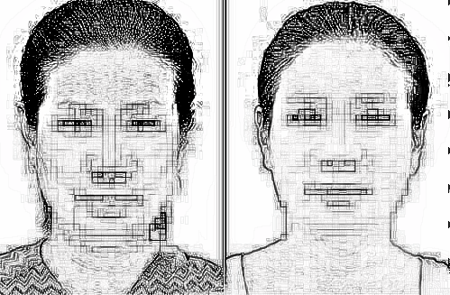 去除抬头纹多少钱 可以长期去除吗
