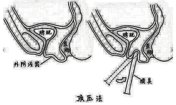 私密再造手术是怎么做的 术后还能生育吗