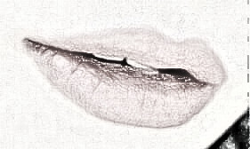 嘴唇先天性发育畸形 重唇修复手术果理想