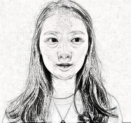 南京黄金龙医生做了隆鼻手术后,鼻子恢复分享