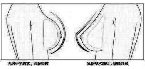 详解假体隆胸怎么样？ 假体隆胸果