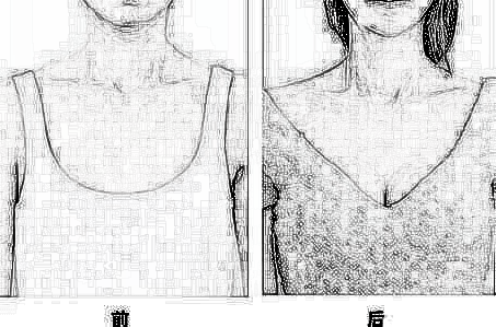 详解假体隆胸怎么样？ 假体隆胸果