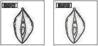 驻马店丽人妇科美容医院漂红没问题吗 多少钱