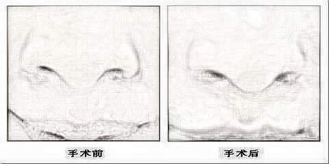 人中再造有哪些方法 人中再造多少钱