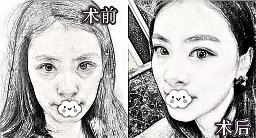 重庆华美整形美容_面部埋线提升果？介绍分享