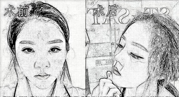杭州东方医疗美容宋亚芬做鼻部手术果怎么样？介绍|
