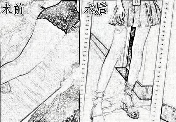 厦门安黛美医疗整形美容大腿吸脂，我也拥有纤纤细腿啦